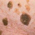 Description: http://www.your-doctor.net/dermatology_atlas/rwx/rwx/Seborrhoeic_keratosis.jpg